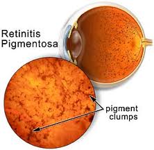 Tipiche chiazze di pigmento sulla retina